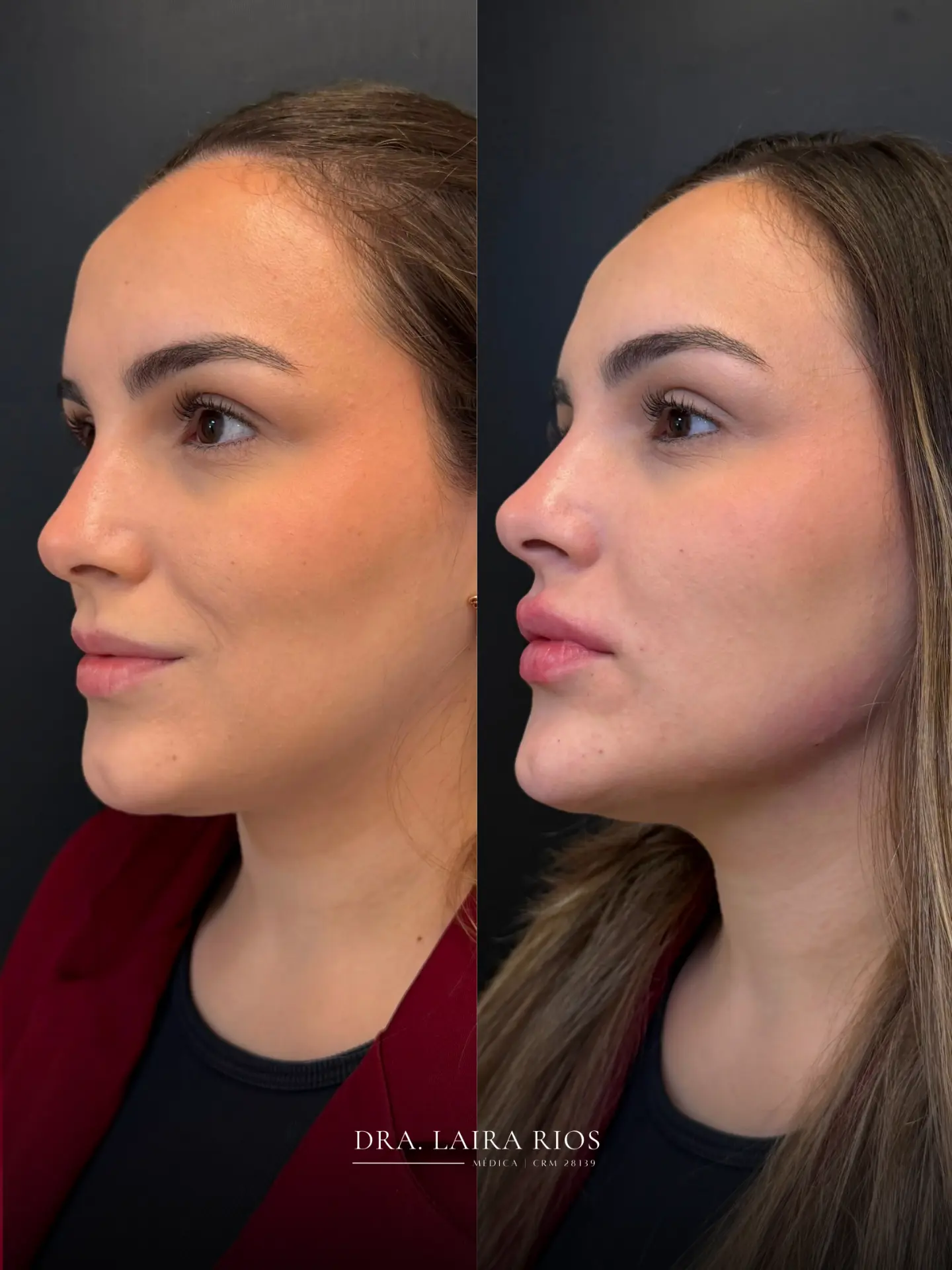 Antes e depois — Harmonização facial com naturalidade