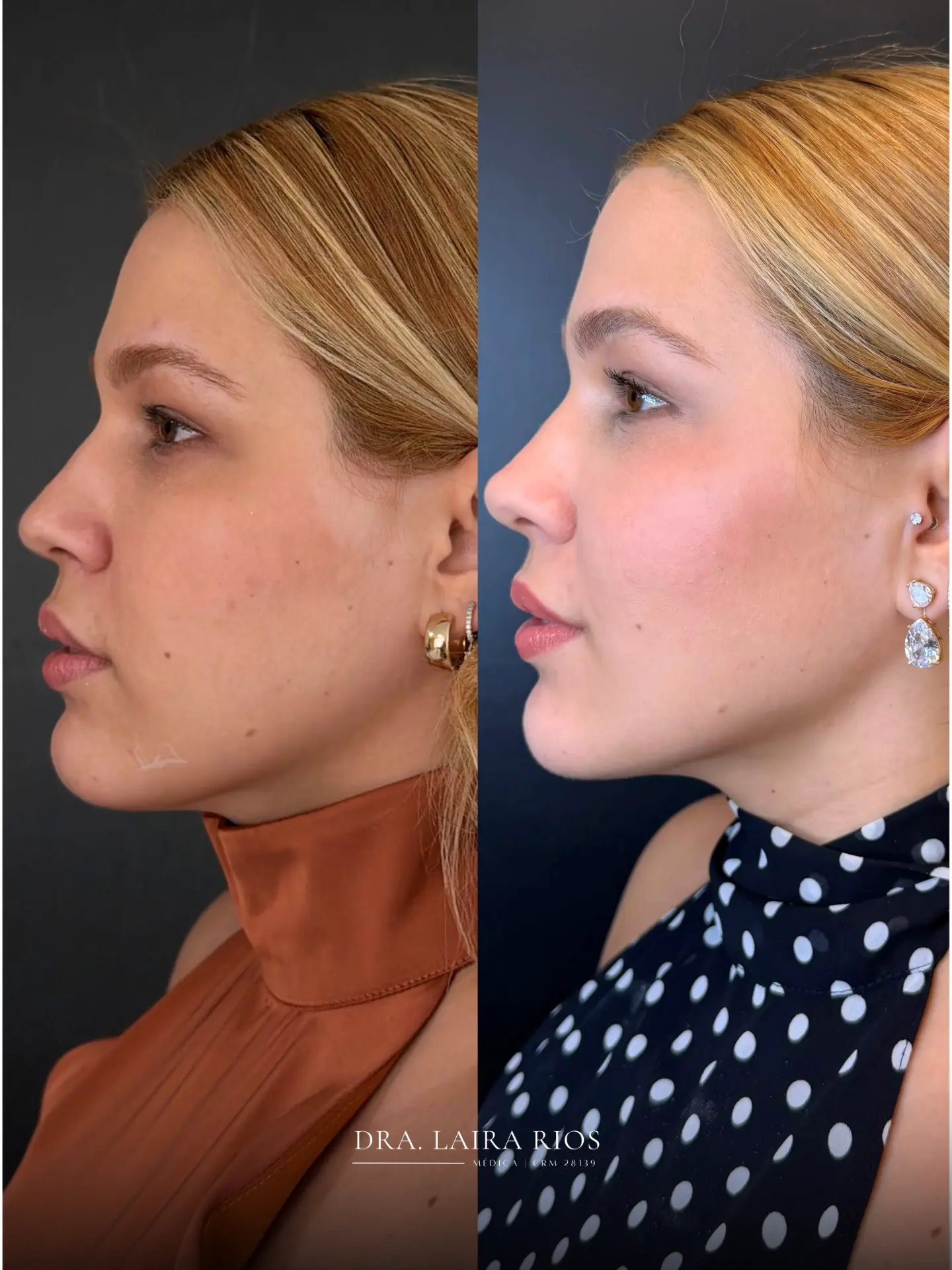 Antes e depois — Definição do terço inferior