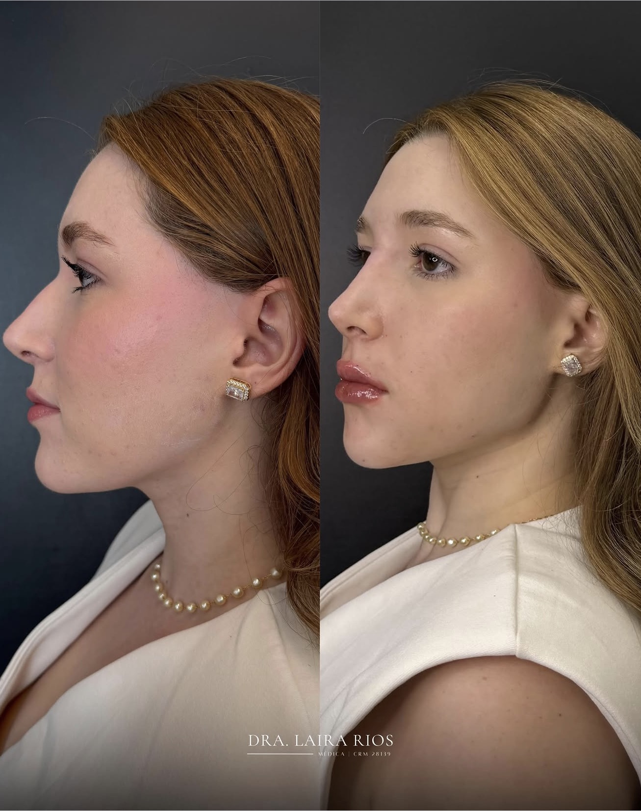 Antes e depois — Perfil e projeção labial