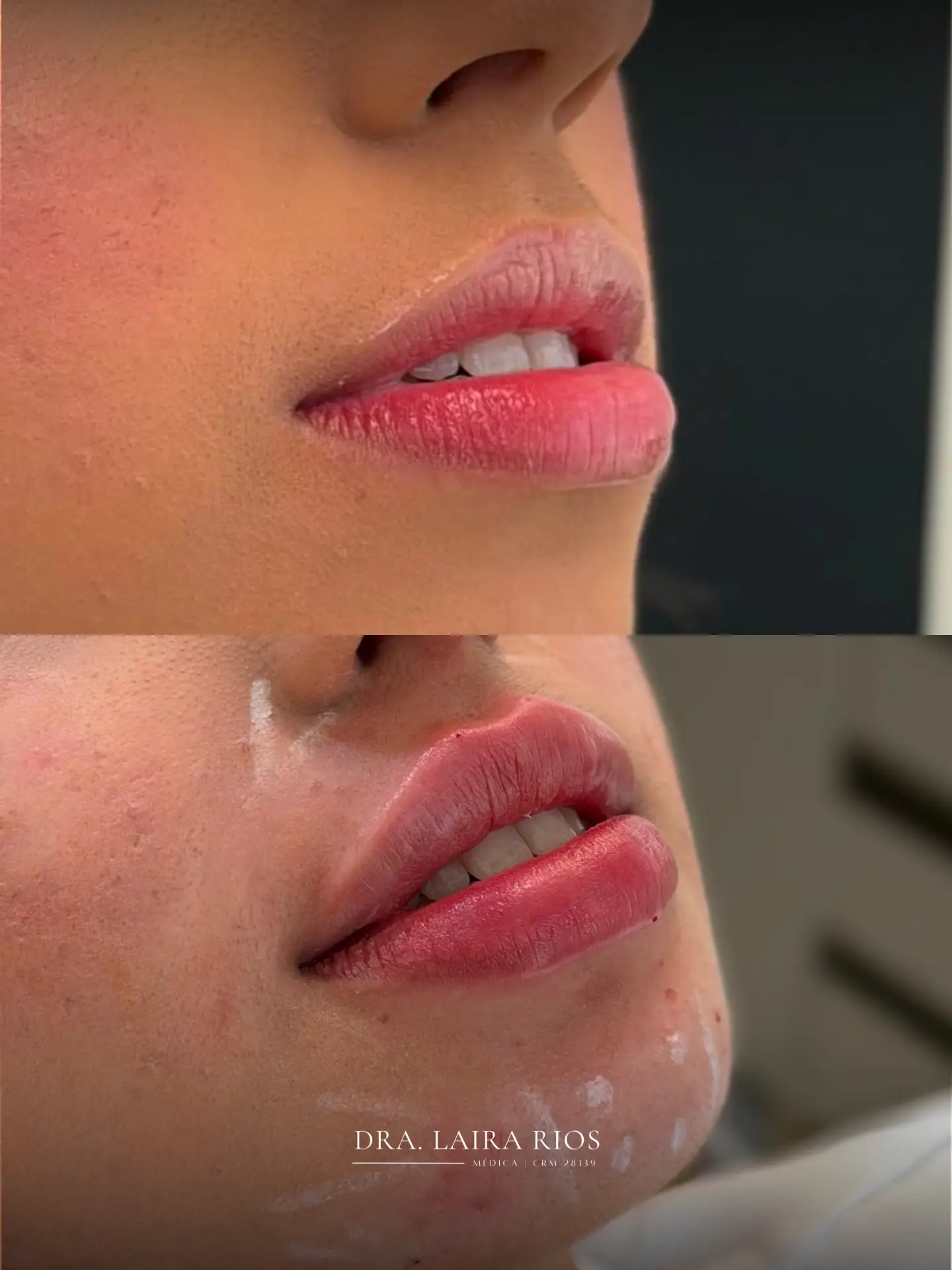 Antes e depois — Preenchimento labial com contorno definido