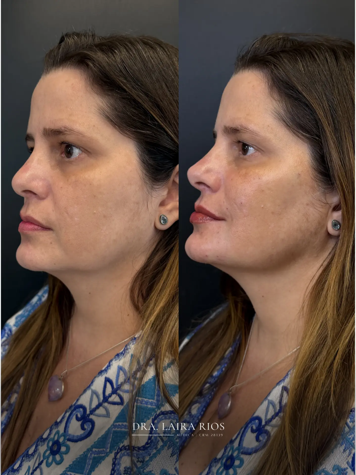 Antes e depois — Contorno facial e definição de mandíbula