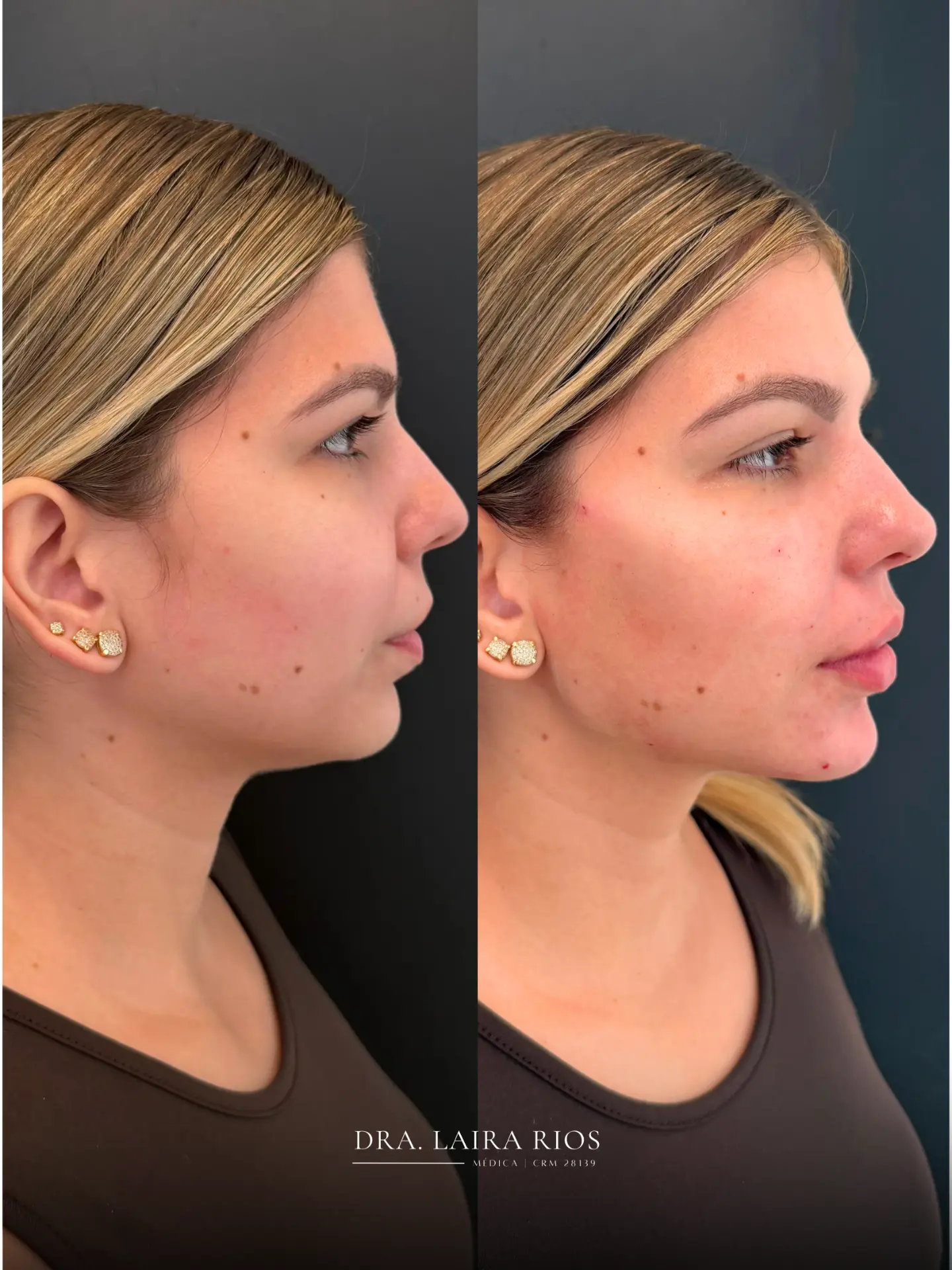 Antes e depois — Equilíbrio de perfil e mento